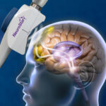 How NeuroStar TMS Therapy Works
